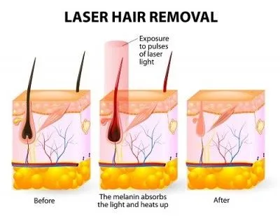 Laser Treatment For Hair Removal – Laser Hair Removal For Face