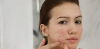 Home Remedies for Pimples - Treatment of Pimples on Faces
