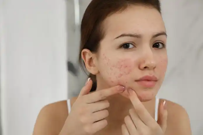 Home Remedies for Pimples - Treatment of Pimples on Faces