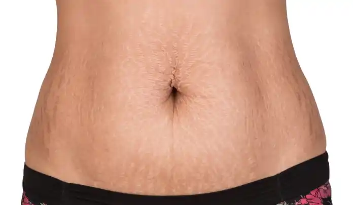 How to Remove Stretch Marks of Stomach