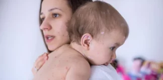 Baby Acne: Causes of Baby Acne and Home Remedies