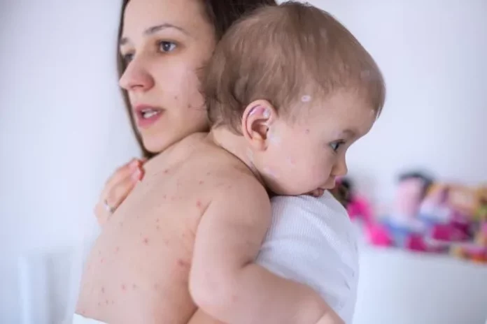Baby Acne: Causes of Baby Acne and Home Remedies