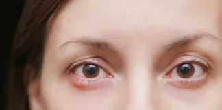 Home Remedies For Eye Infection in Children